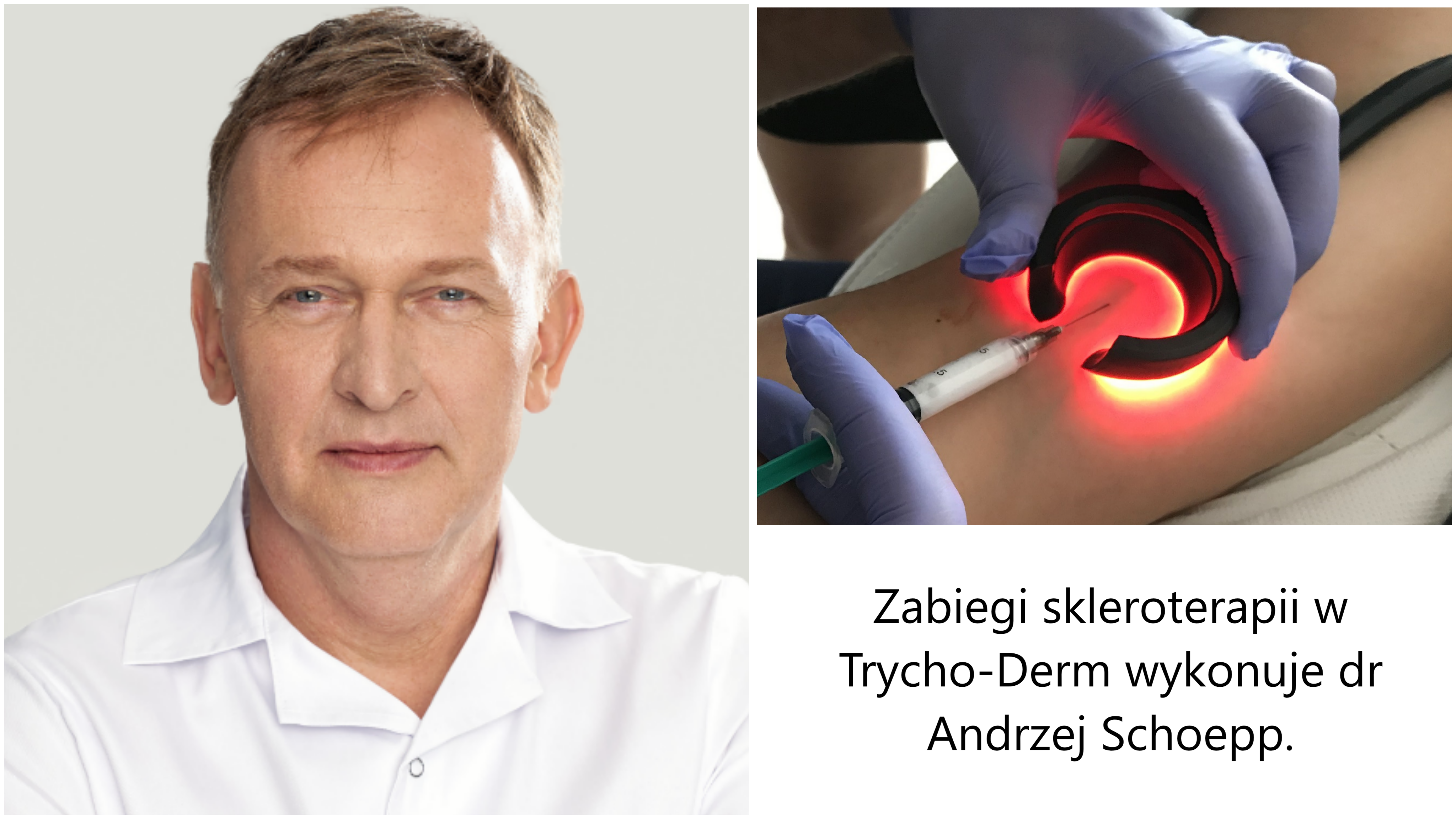 Usuwanie żylaków Głogów metoda skleroterapia dr Andrzej Schoepp